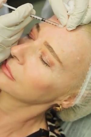 Θεραπεία Βοτουλινικής Τοξίνης (BOTOX)
