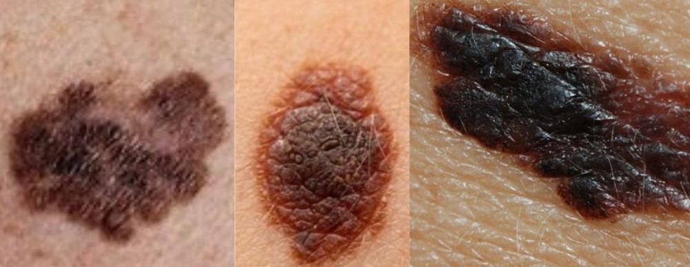 melanoma.jpg