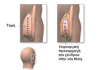 Ωτοπλαστική